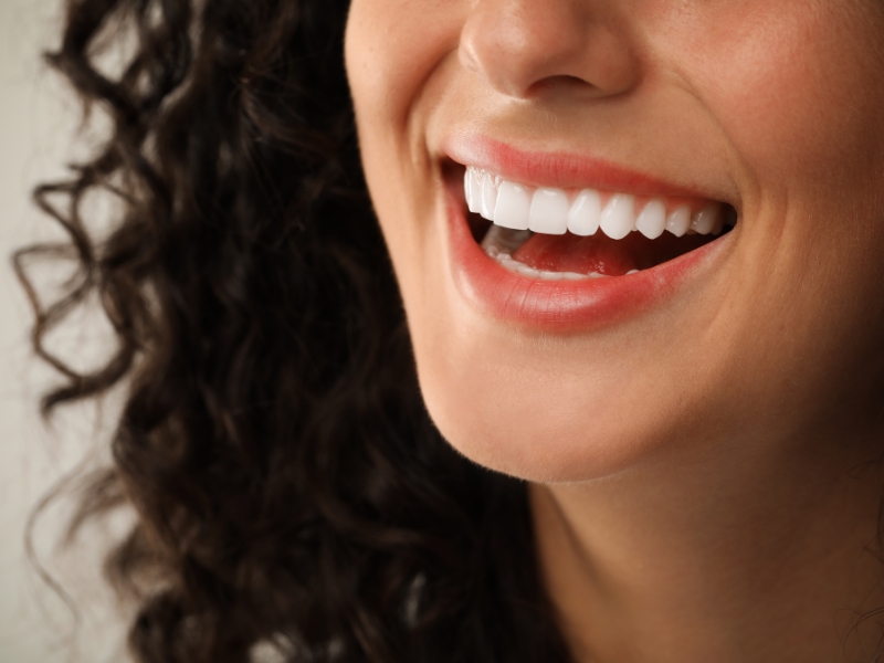 Faccette dentali