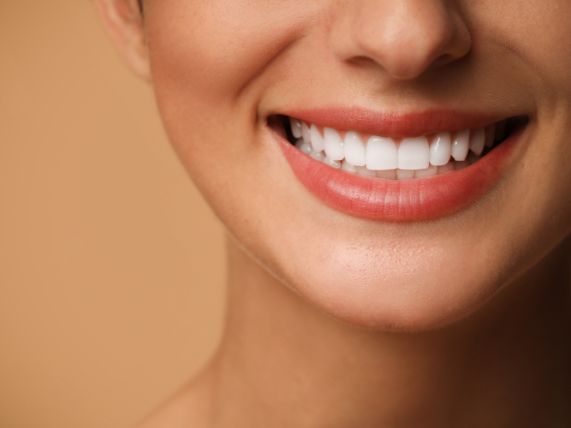 Faccette dentali