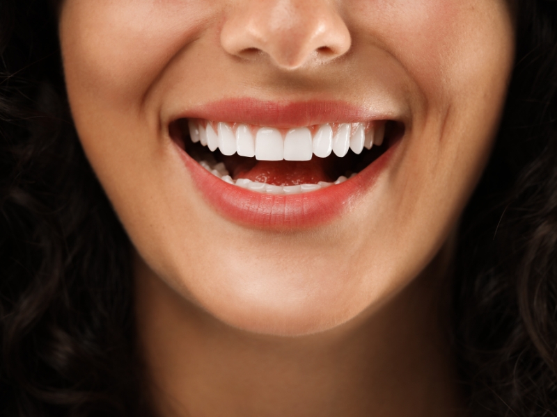 Faccette dentali