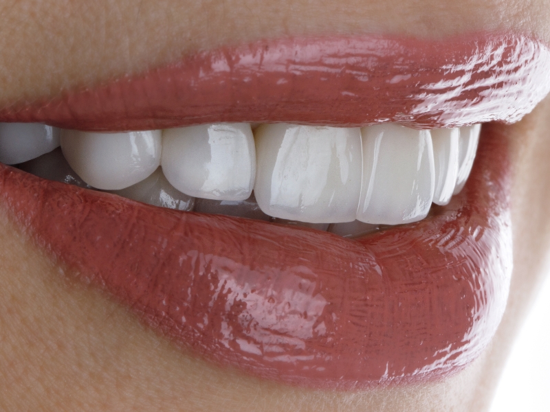 Faccette dentali